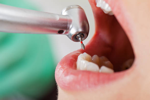 Best Urgent Care for Lost Fillings or Crowns in Weston, OH